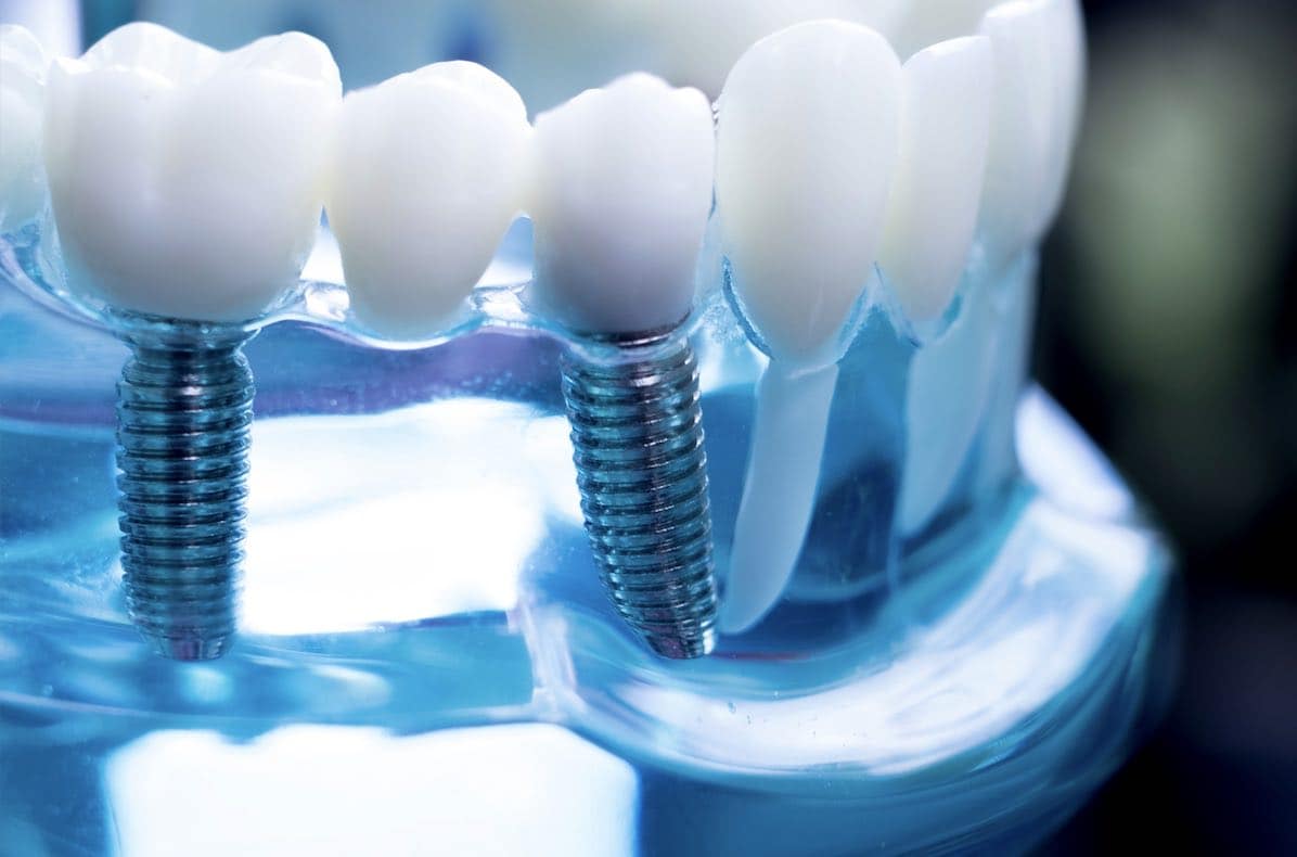 how many dental implants do i need