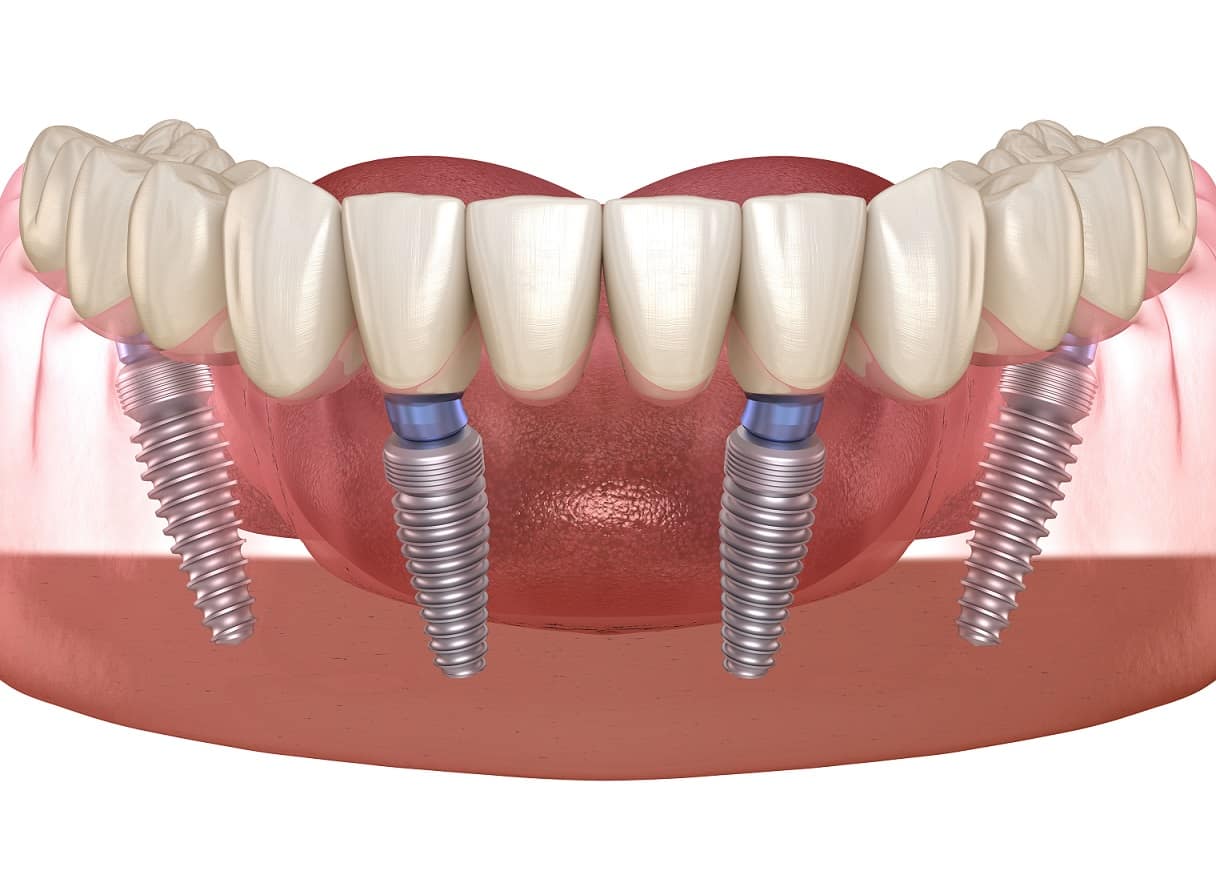 all on 4, dental implants all on 4