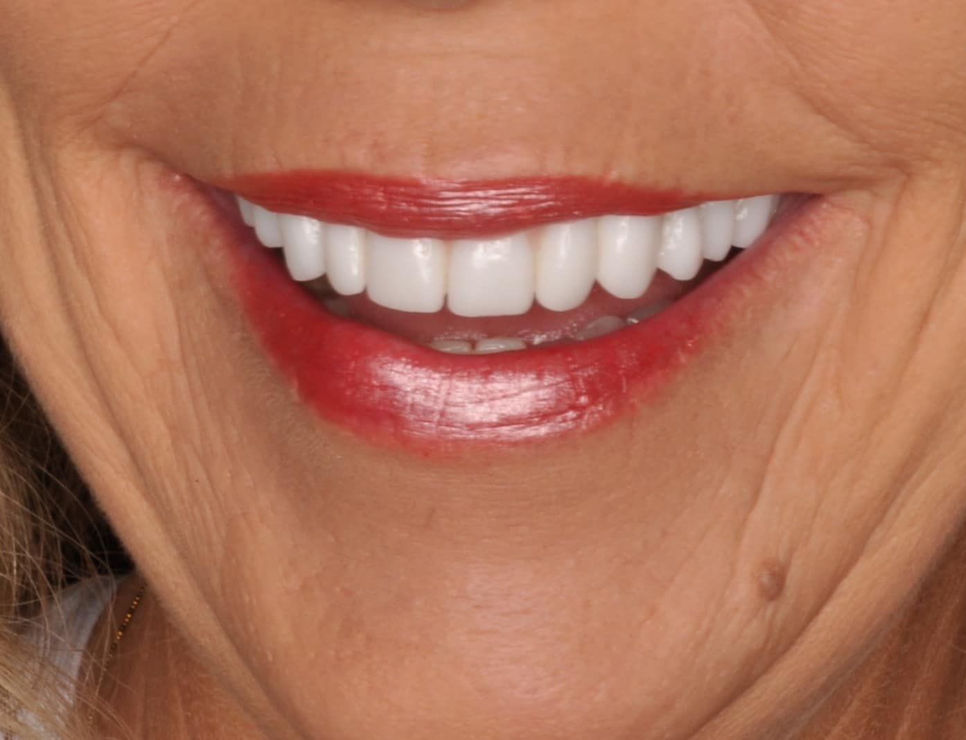 zirconia dental implants, zirconia bridges