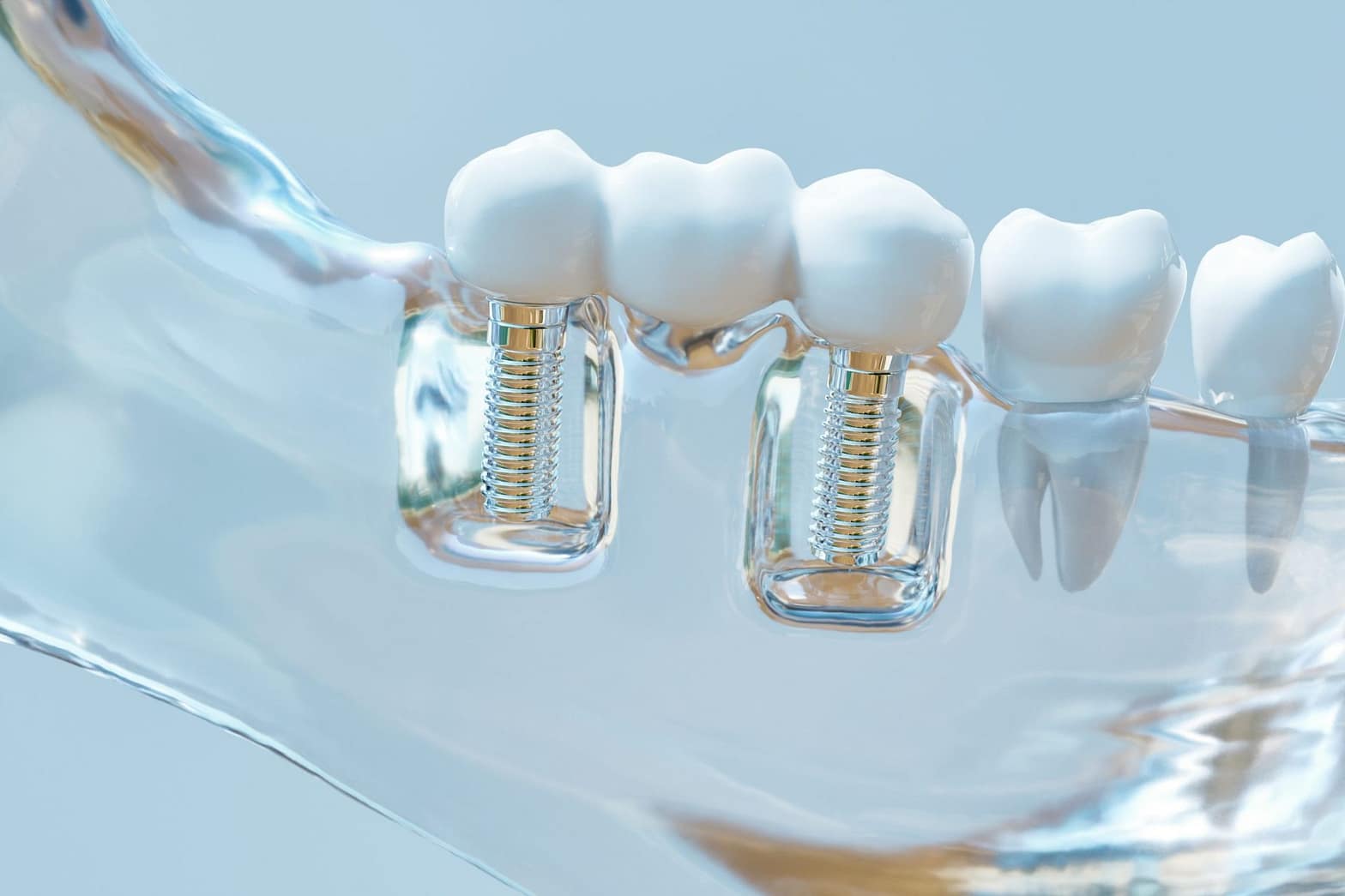 dental implant failure causes, what causes dental implants to fail?