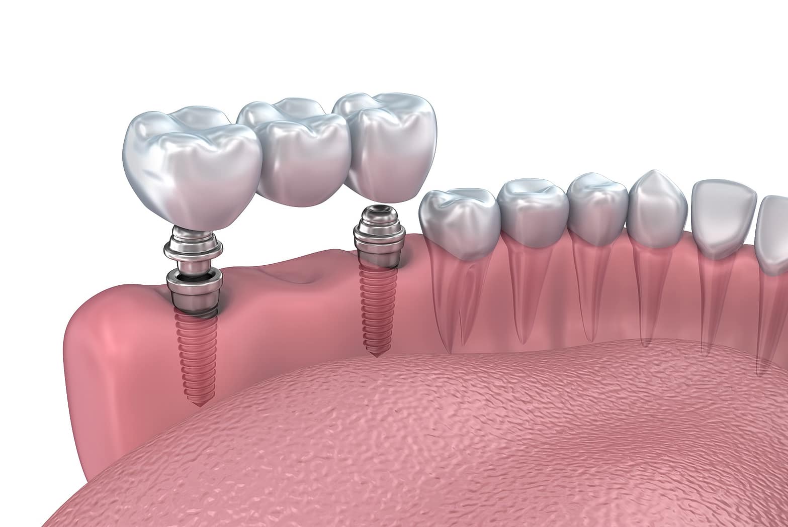 cheap dental implants dallas tx