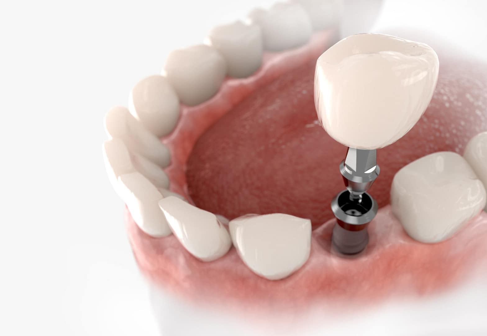dental implant and crown example
