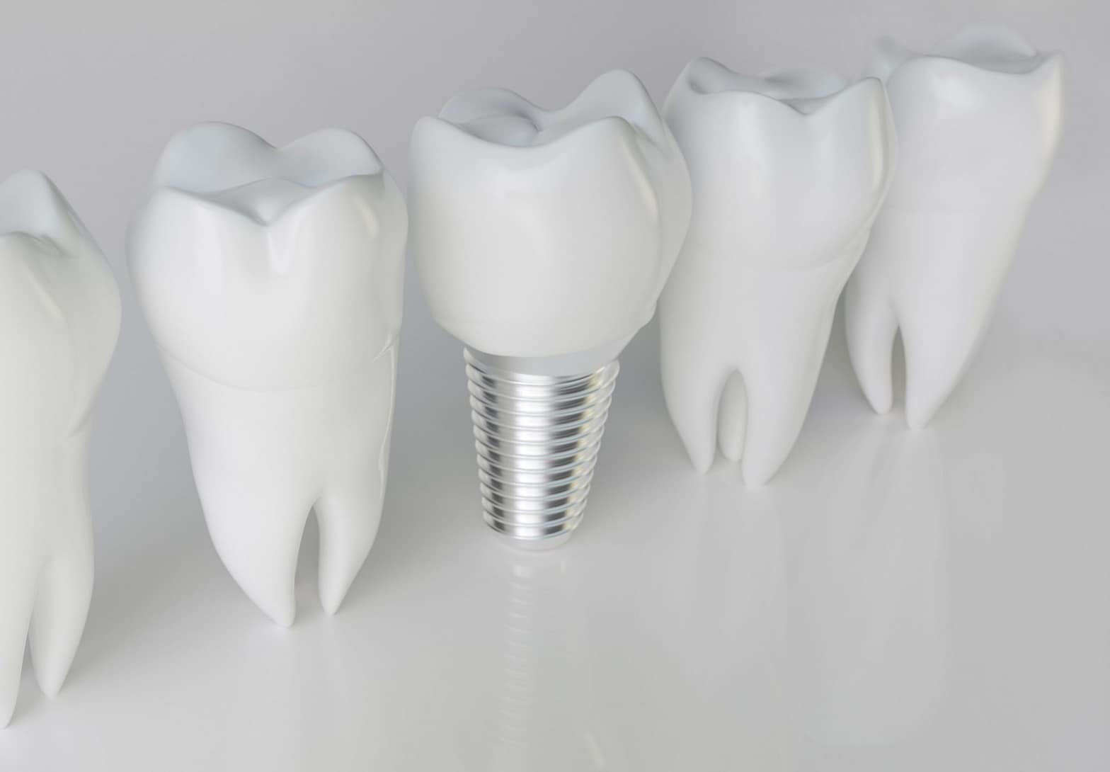 financing dental implants with bad credit