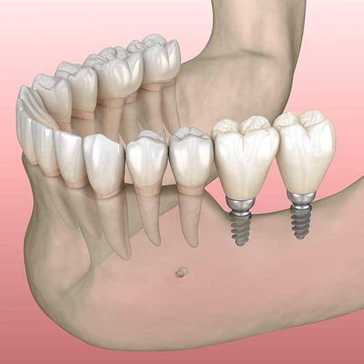 What are mini dental implants? Medically accurate 3D illustration