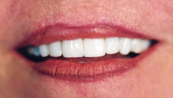 dental implant picture, dental implants benefits