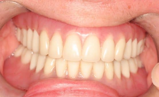 same day implants, dental implants one day {{brizy_dc_image_alt imageSrc=