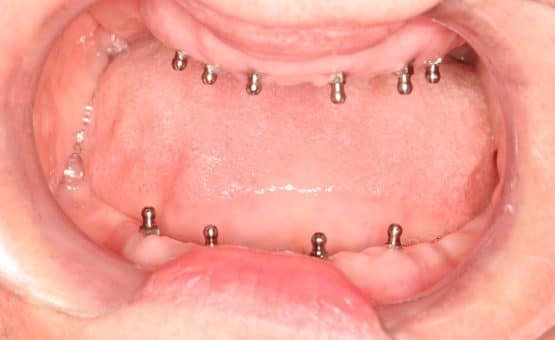 Before picture new teeth one day {{brizy_dc_image_alt imageSrc=