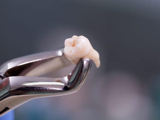 same day tooth extraction, extractions and implants {{brizy_dc_image_alt imageSrc=