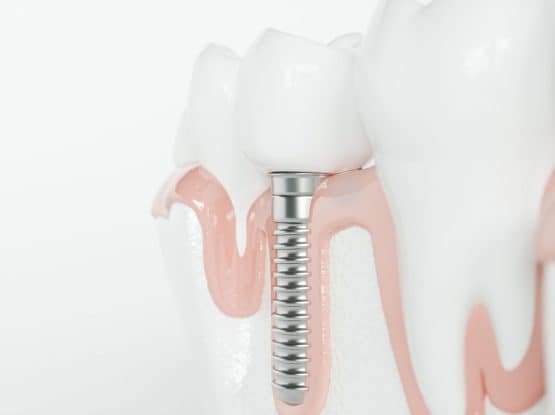 mini dental implants, mini implants {{brizy_dc_image_alt imageSrc=