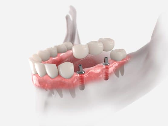 same day dental implant bridge {{brizy_dc_image_alt imageSrc=