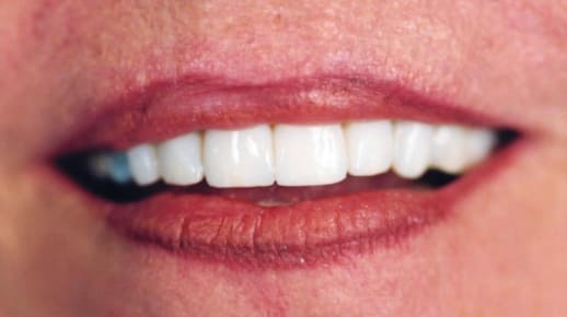 full mouth dental implants fort worth tx {{brizy_dc_image_alt imageSrc=